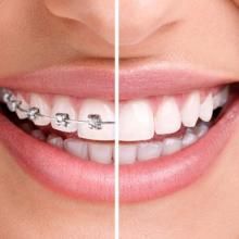 Máxima estética Ortodoncia Invisible en Tenerife