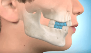Ortopedia funcional estimular frenar crecimiento mandibular