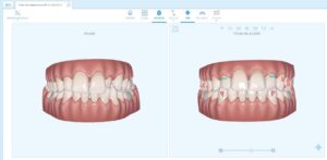 Plan tratamiento ortodoncia Invisible en Tenerife