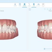 Simulación Virtual del Tratamiento Ortodoncia Invisible en Tenerife