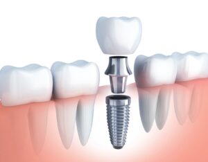 Preguntas frecuentes sobre implantes dentales en Tenerife