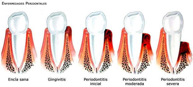Evolución de la Inflamación de encías a la periodontitis